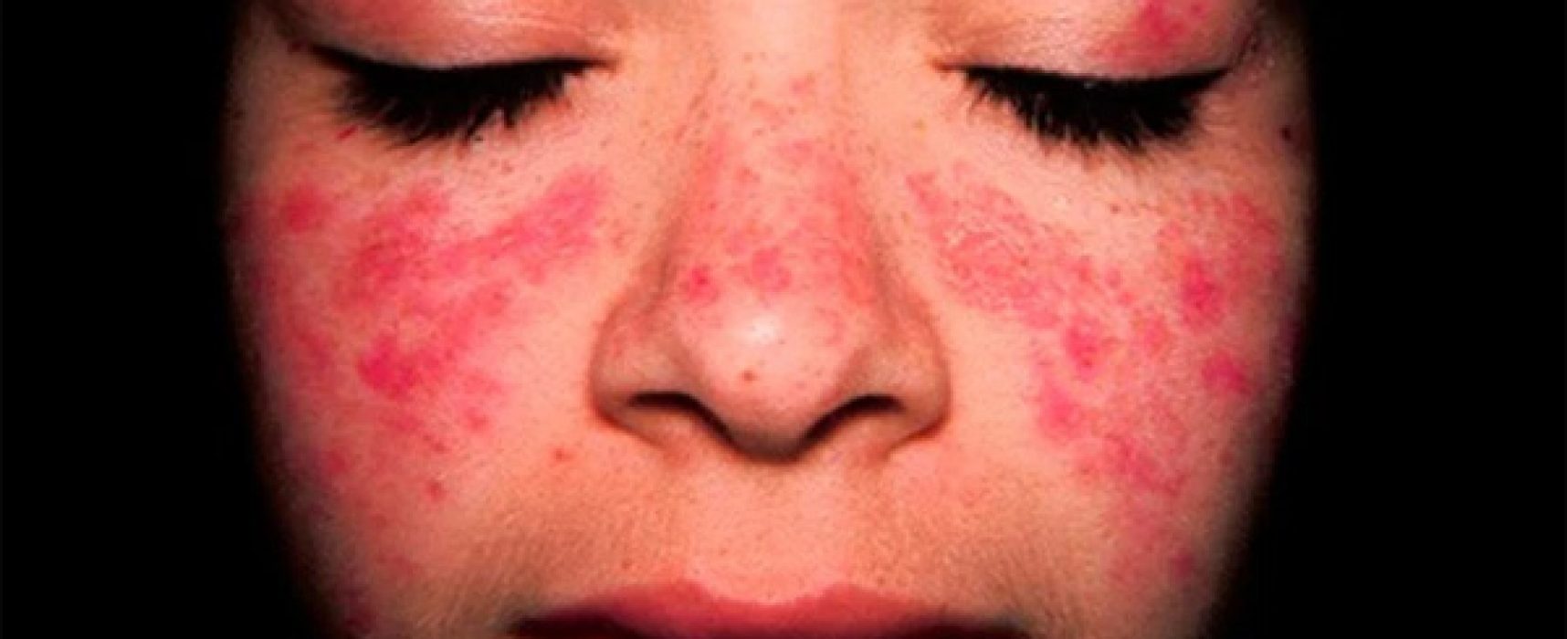 Lúpus atinge mais de 200 mil de brasileiros. Você conhece a doença?