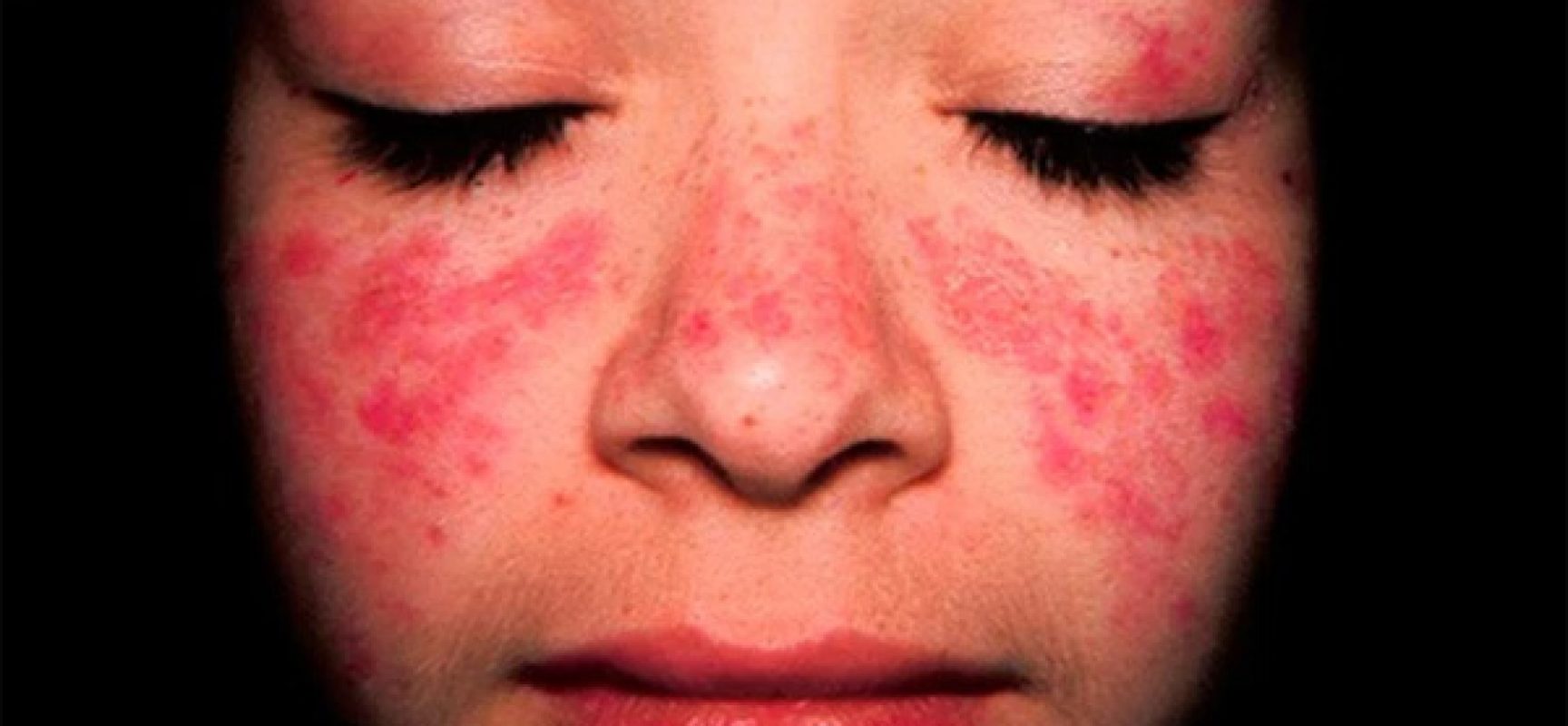 Lúpus atinge mais de 200 mil de brasileiros. Você conhece a doença?