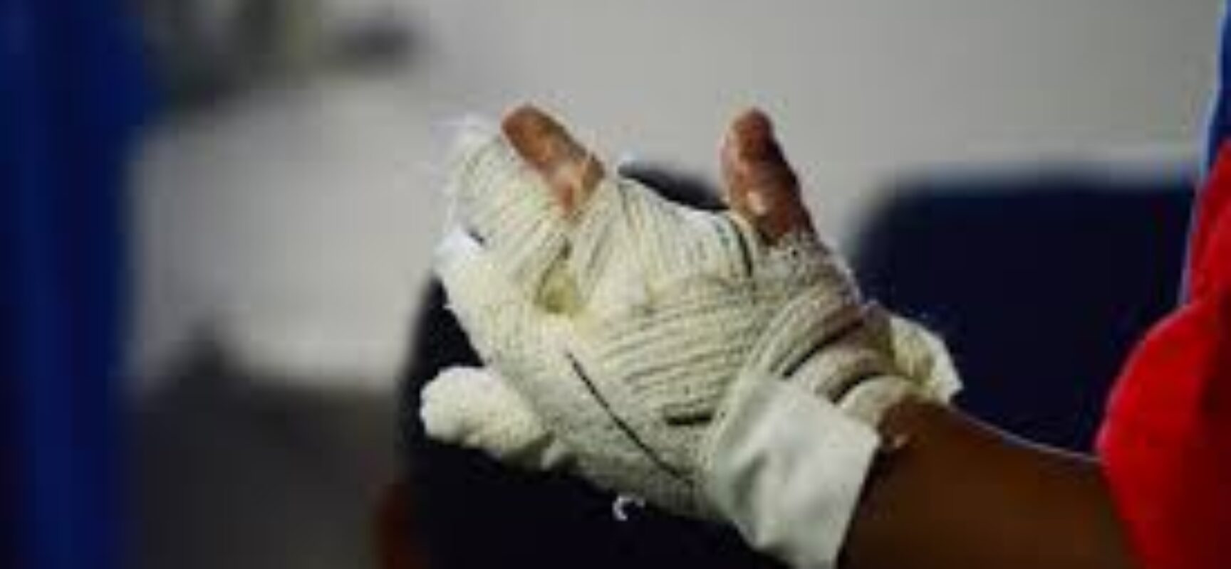 Hospitais registram 40 casos de queimaduras por fogos e fogueiras