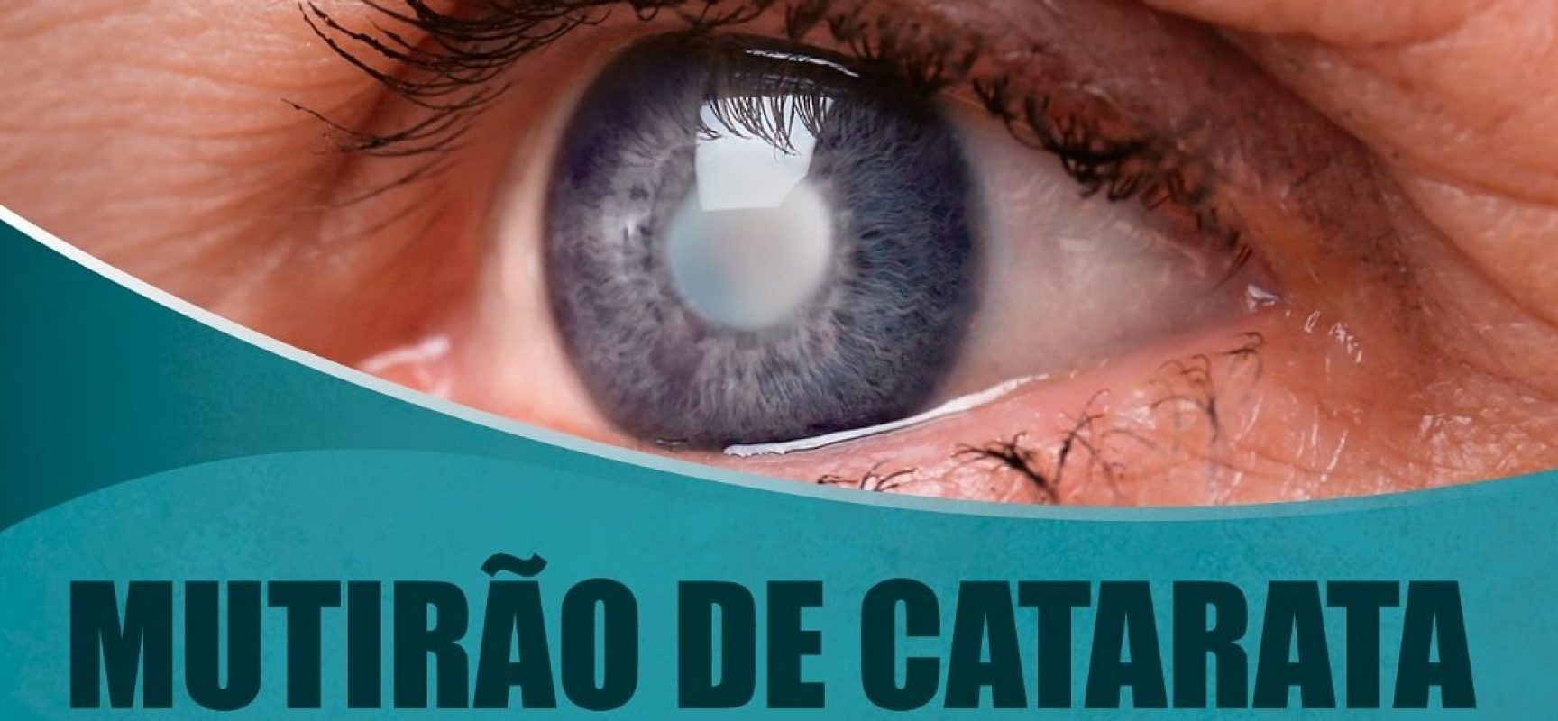 Prefeitura de Una realiza triagem para mutirão de cirurgia de catarata