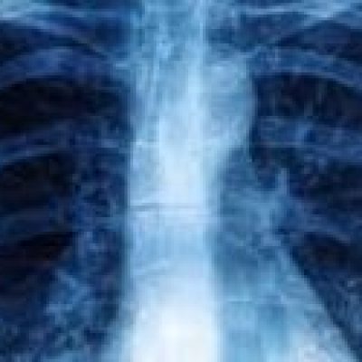 Trabalhar em espaço com raio-x móvel não dá direito à adicional de periculosidade