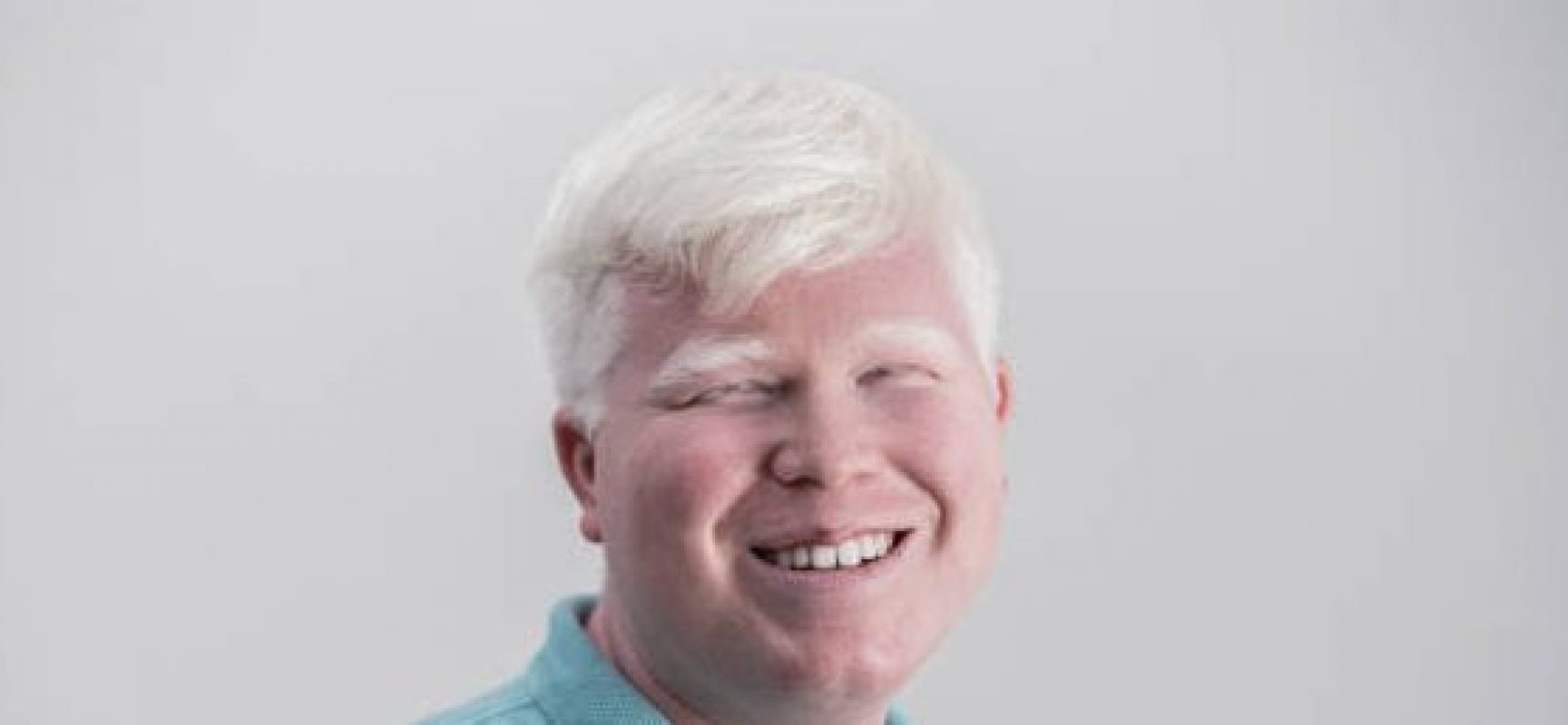 Comissão aprova obrigação de o SUS fornecer protetor solar e óculos escuros a albinos