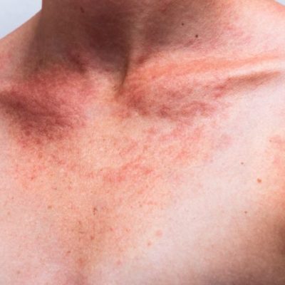 Seis estados brasileiros têm estimativa de maior índice de câncer de pele