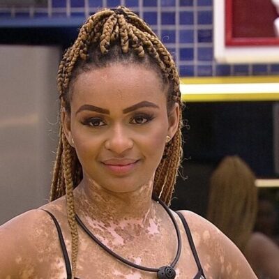 Participante do BBB com vitiligo amplia debate sobre autoestima e aceitação