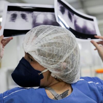 Médico alerta para riscos da tuberculose pulmonar não tratada
