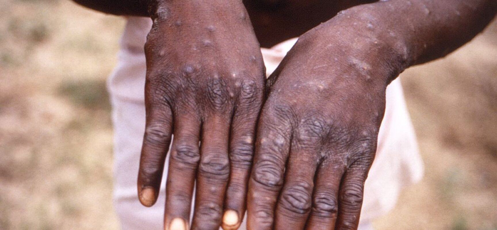 Portugal confirma 5 casos de varíola dos macacos e investiga outros 20