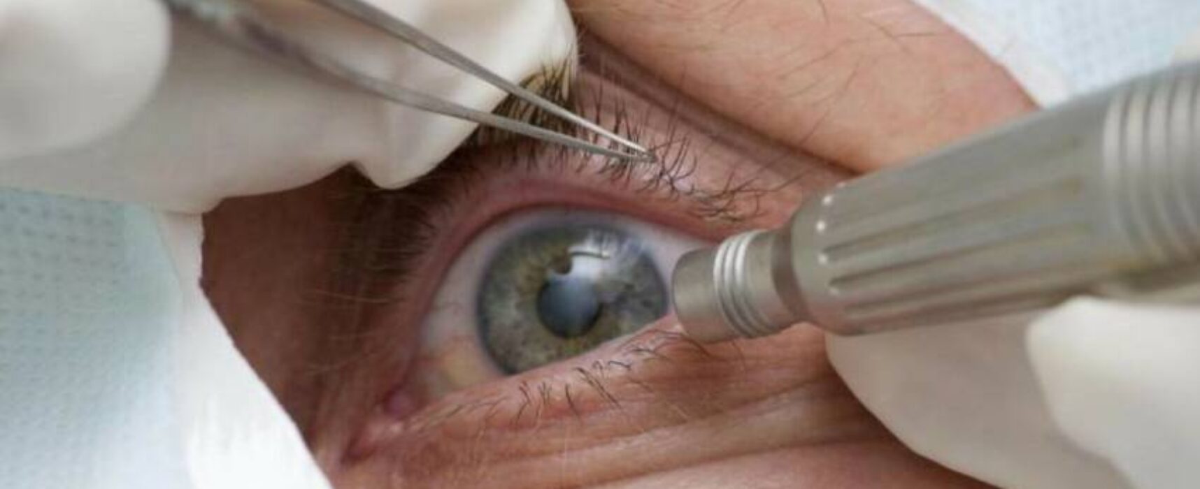 Doença ocular relacionada à idade pode levar à cegueira