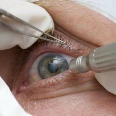 Doença ocular relacionada à idade pode levar à cegueira