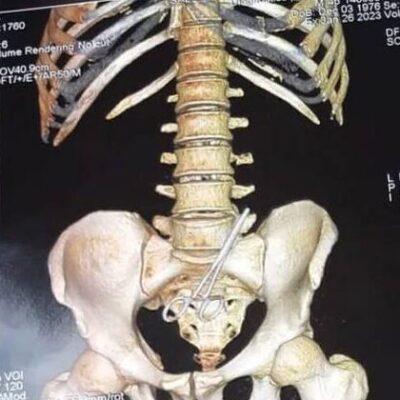Tesoura é encontrada dentro da barriga de vereador após cirurgia