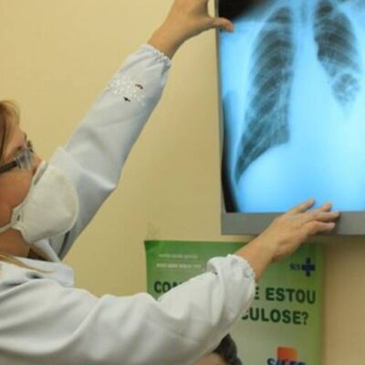 Conselho aprova novas diretrizes para tratamento da tuberculose no SUS