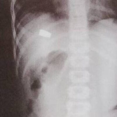 Criança de 8 anos é baleada enquanto brincava