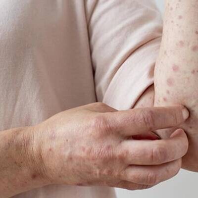 Mpox não é nova Covid, tranquiliza autoridade da OMS