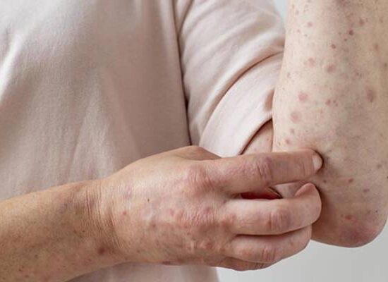 Mpox não é nova Covid, tranquiliza autoridade da OMS