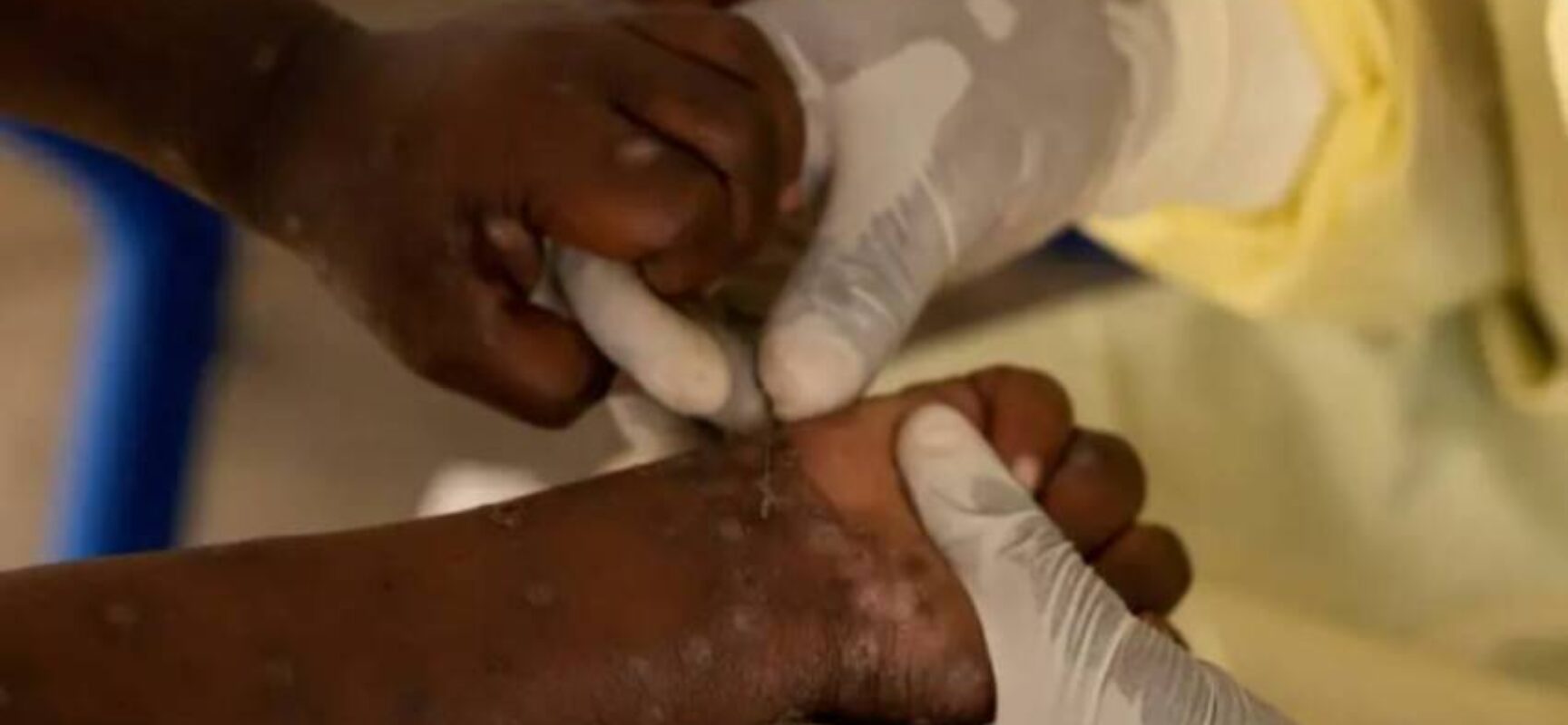 África: Congo tem mais de 18 mil casos e 615 mortes por Mpox