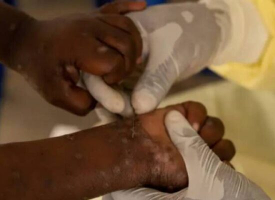 África: Congo tem mais de 18 mil casos e 615 mortes por Mpox