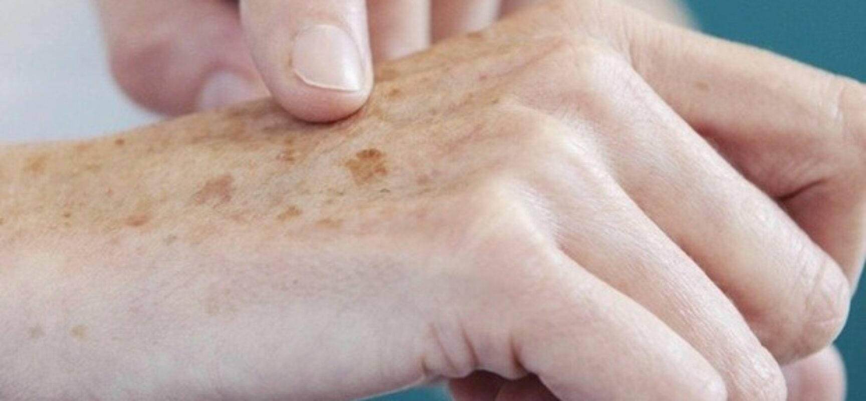 VERÃO: Projeto do Vereador EDERJÚNIOR dispõe sobre os cuidados ao câncer de pele