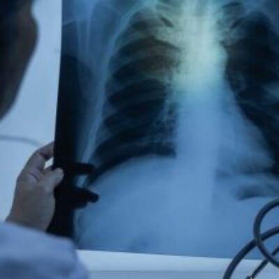 Lei institui campanha para conscientização sobre câncer de pulmão