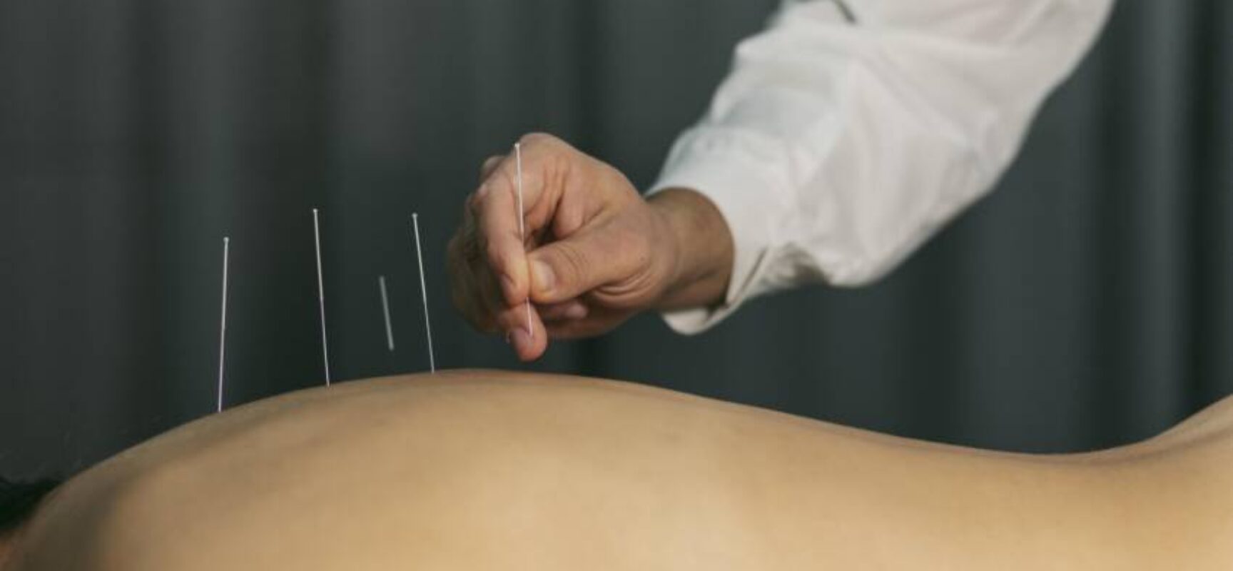 Governo federal regulamenta atuação profissional da acupuntura no Brasil