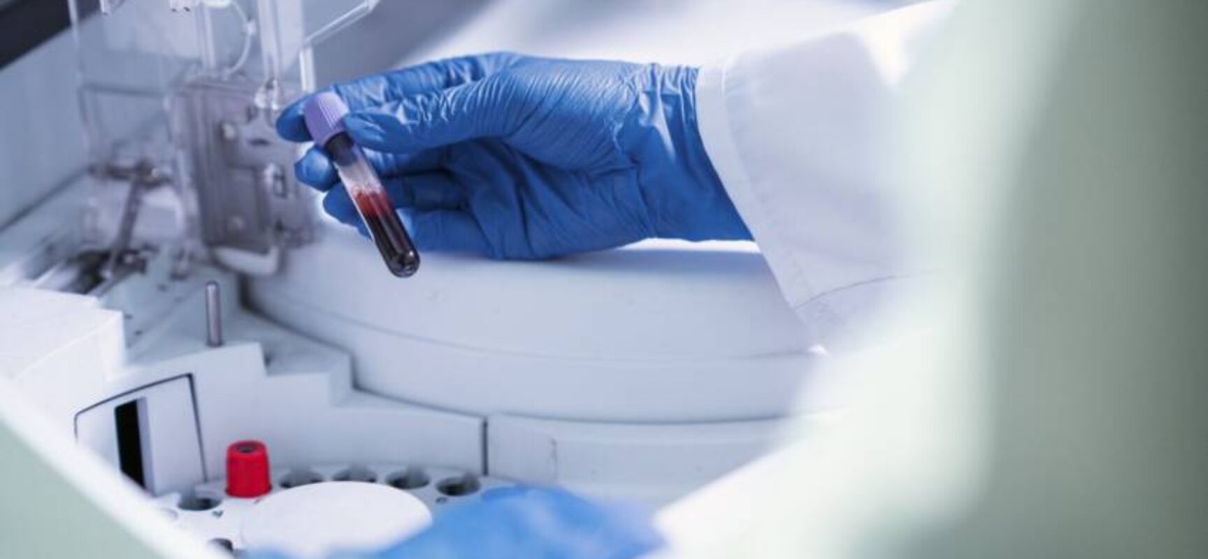 Exame de sangue para detectar Alzheimer chega ao Brasil
