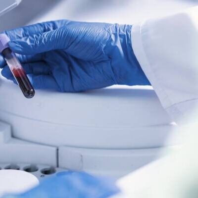 Exame de sangue para detectar Alzheimer chega ao Brasil